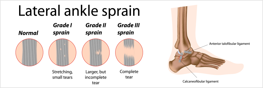 Diagram of an ankle joint illustrating how a sprain affects the ligaments in different grades, severity, or degrees.