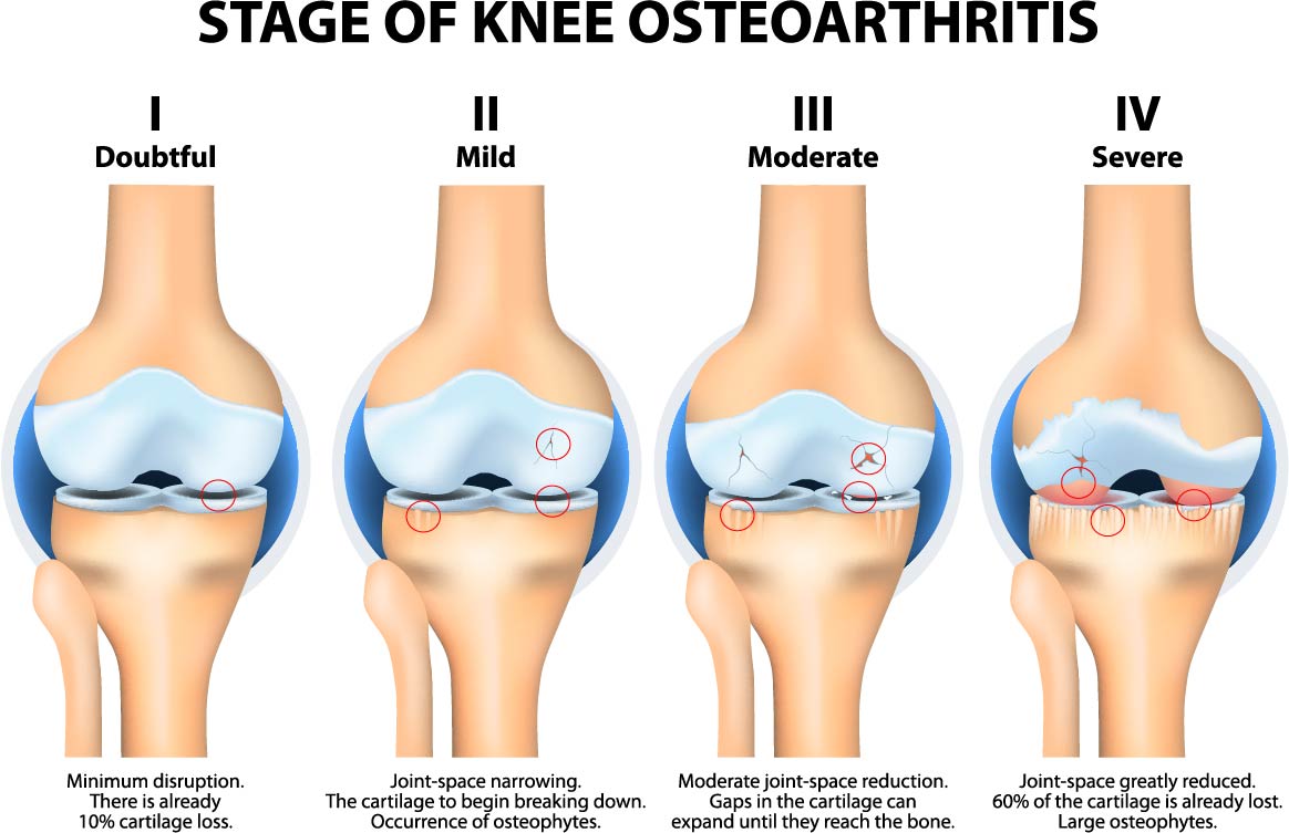 The four stages of Osteoarthritis progression from minor to severe