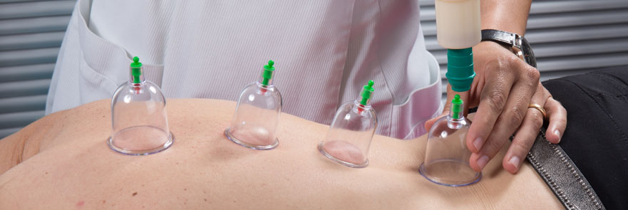 Clinician applies cupping cups to patient's back