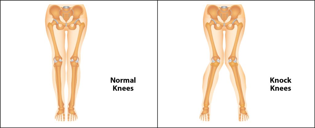 Illustration of Knock Knees vs Illustration of normal knees