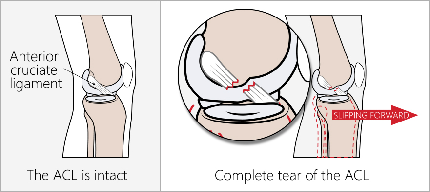 Side view illustration of knee anatomy showing a complete tear of the ACL