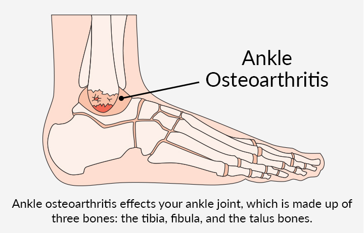 Diagram of Ankle Osteoarthritis. Ankle osteoarthritis effects your ankle joint, which is made up of three bones: the tibia, fibula, and the talus bones.