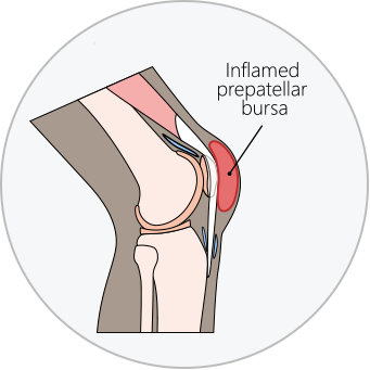 Diagram of Knee Bursitis (Inflamed prepatellar bursa).