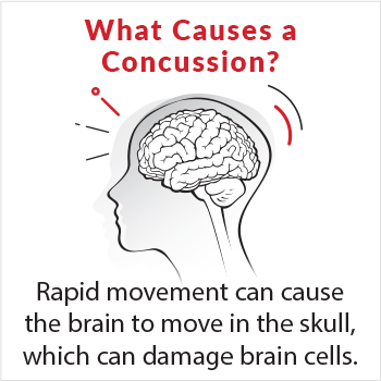 Image of what causes a concussion. Rapid movement can cause the brain to move in the skull, which can damage brain cells.