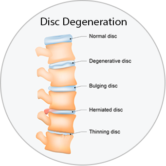 Medical diagram of a spine showing a normal disc, a degenerative disc, a bulging disc, a herniated disc, and a thinning disc. 