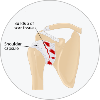 Medical diagram of frozen shoulder showing a build up of scar tissue in the shoulder capsule