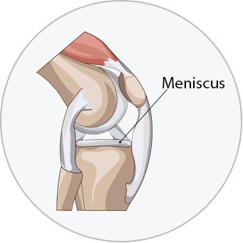 medical diagram of a meniscus