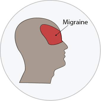 medical illustration of the location of a migraine headache over the eyes in the front of the face