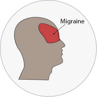 migraine headache diagram