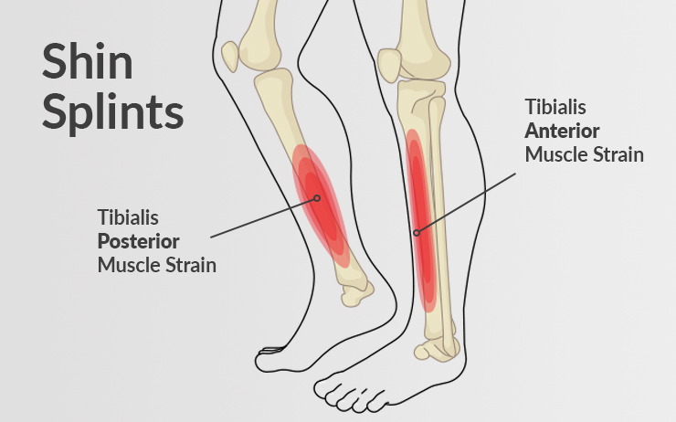 A medical diagram showing shin splints, both tibialis posterior muscle strain and the tibialis anterior muscle strain