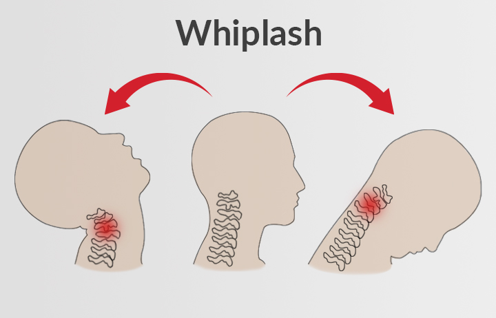 Medical illustration of a neck injury from Whiplash showing whiplash associated disorder (WAD).